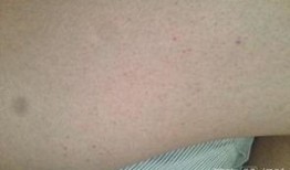 紫癜可以吃梨瓜,梨瓜助力健康恢复