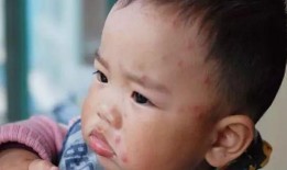 小孩子长水痘可以吃瓜吗,瓜类食物的适宜摄入