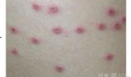 水痘可以吃小瓜,小瓜助力健康恢复