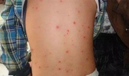 小孩子长水痘可以吃瓜吗,瓜类食物的适宜摄入